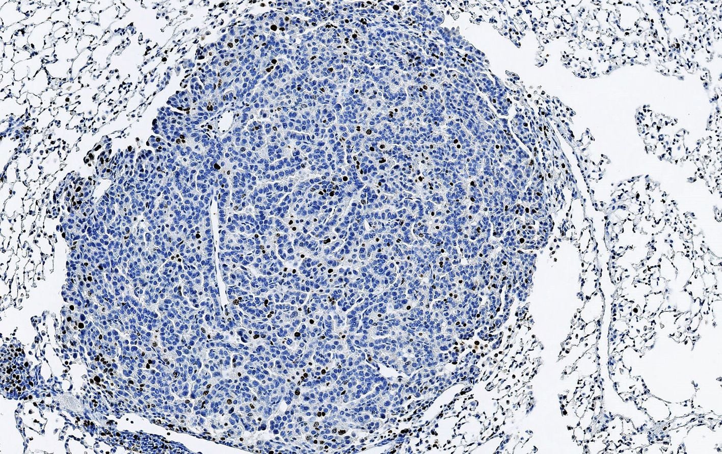 Vista microscópica del cáncer de pulmón (IRB) 