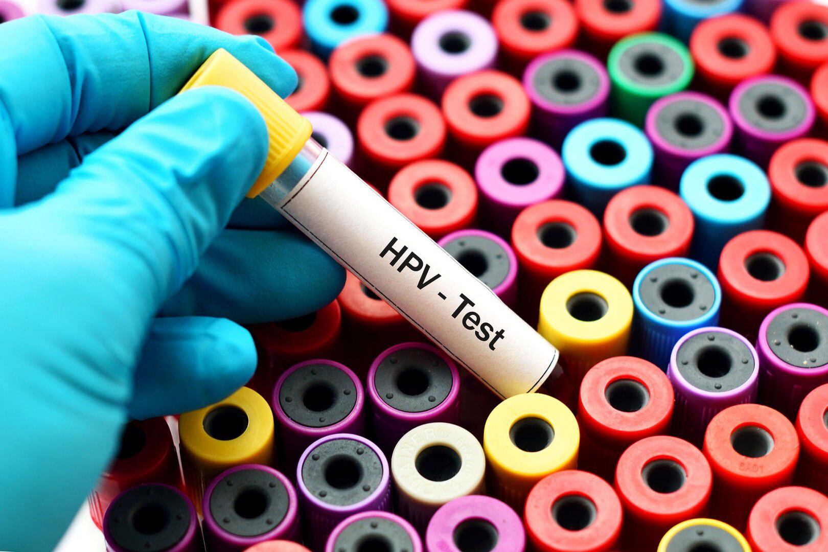 El test de VPH puede detectar la presencia de material genético de virus con alto riesgo oncogénico (Getty Images)