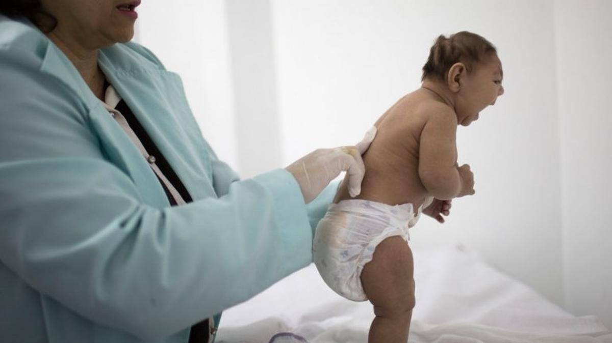 El Zika puede llevar a un defecto de nacimiento llamado microcefalia (AP)