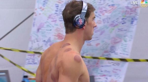 Las contusiones en la espalda de Phelps son efecto de la técnica china de “cupping”
