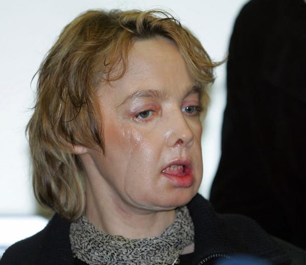 Isabelle Dinoire en 2006, meses despus de haber sido operada