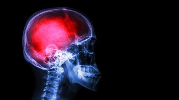 El 73% de los argentinos asegura conocer los síntomas de un ACV (iStock)