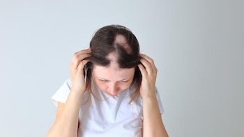 Agonistas del receptor GLP-1 pueden aumentar el riesgo de alopecia