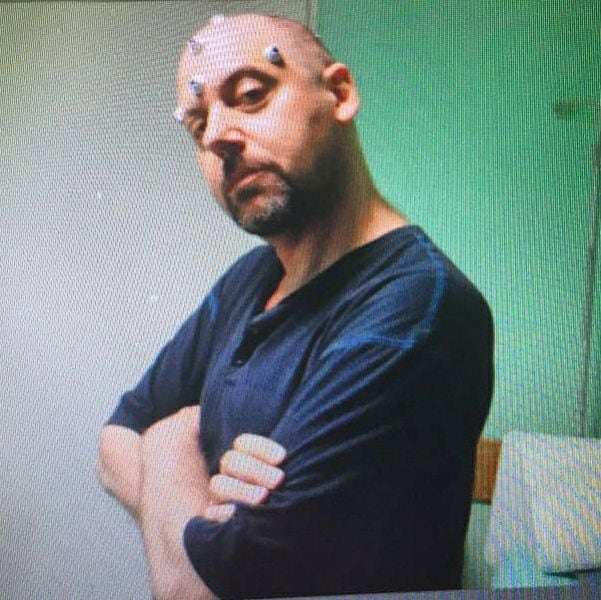 El músico Alejandro Marcovich posa con marcadores quirúrgicos en su cabeza antes de una compleja intervención para extirpar tumores cerebrales en 2010. (Alejandro Marcovich: Instagram)