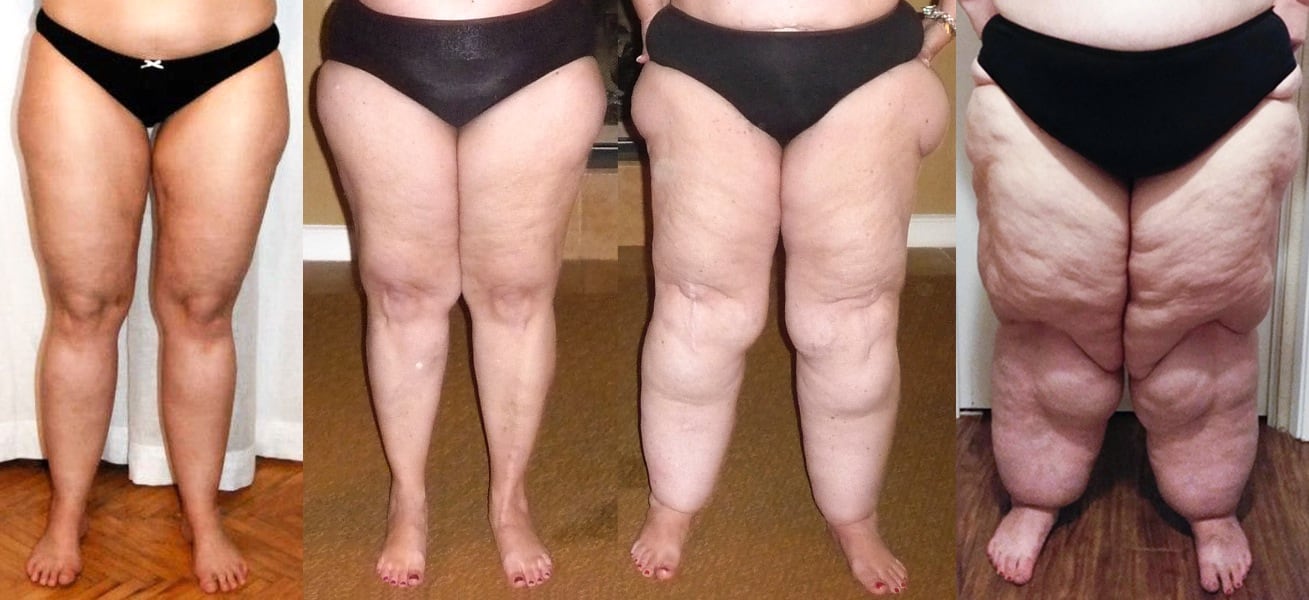 El carácter progresivo del lipedema no implica que la enfermedad empeore del mismo modo en todas las personas (The Lipedema Project)