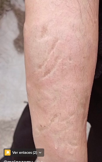 Ataque de ácido en contra