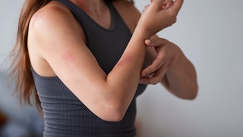 Alergia al níquel: causas, síntomas y tratamiento