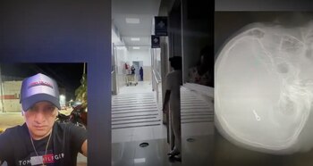 Joven terminó con una pinza