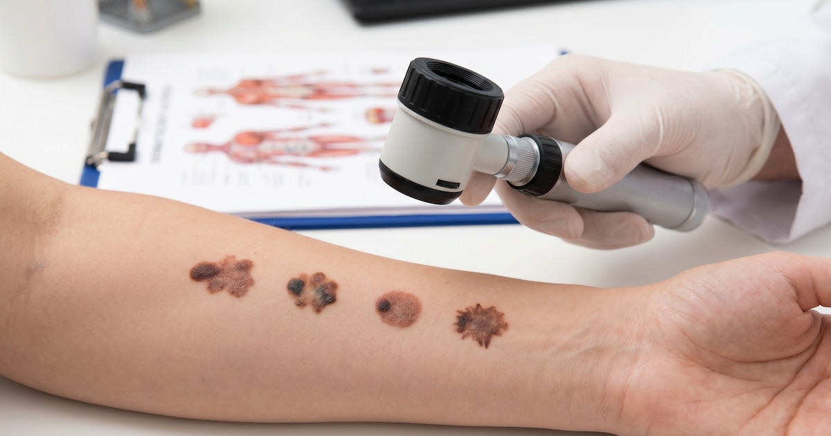 How skin cancer looks: the four signs that you should consult a doctor
