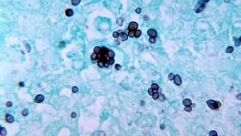 Las formas más leves de