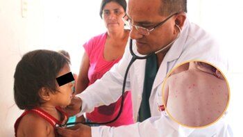 La vacuna contra la varicela