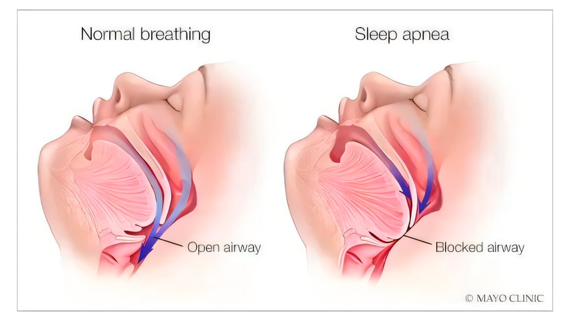La apnea obstructiva del sueño ocurre cuando las vías respiratorias se estrechan o bloquean durante el descanso, lo que dificulta el paso del aire y puede provocar interrupciones repetidas de la respiración (Mayo Clinic)
