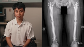 Aaron Trinh, el corredor que se operó para aumentar su estatura inspirado por la experiencia de discriminación que sufrió su padre
