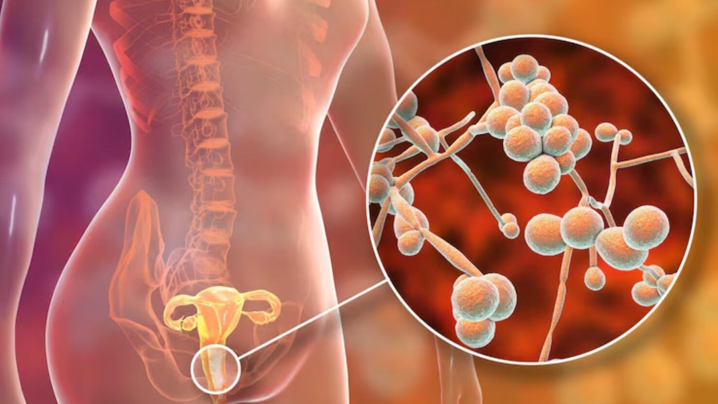 La candidiasis puede afectar la vida íntima, el bienestar digestivo y, en casos graves, comprometer órganos en personas inmunodeprimidas (Freepik)