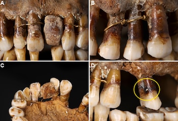 Vista macroscópica del elemento protésico. A, B y D: Vista vestibular; C: Vista oclusal. B: Vista macroscópica vestibular de la ligadura entre el 14 y el 15 (Colleter et al., J. Archaeol. Sci. Rep. , 2023)