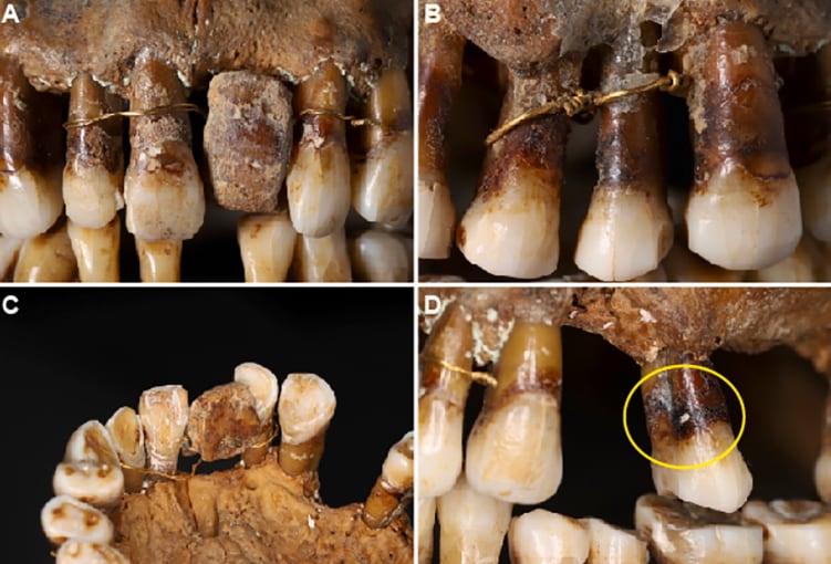 Vista macroscópica del elemento protésico. A, B y D: Vista vestibular; C: Vista oclusal. B: Vista macroscópica vestibular de la ligadura entre el 14 y el 15 (Colleter et al., J. Archaeol. Sci. Rep. , 2023)