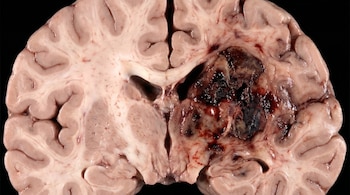 Corte transversal de un cerebro humano que muestra un glioblastoma oscuro, parcialmente rodeado por señales luminosas doradas sobre un fondo negro.