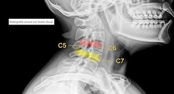 Radiografía lateral de una columna cervical humana, mostrando las vértebras C5, C6 y C7 con áreas resaltadas en rojo y amarillo indicando lesiones.