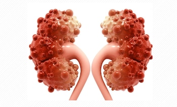 Los quistes son un mal