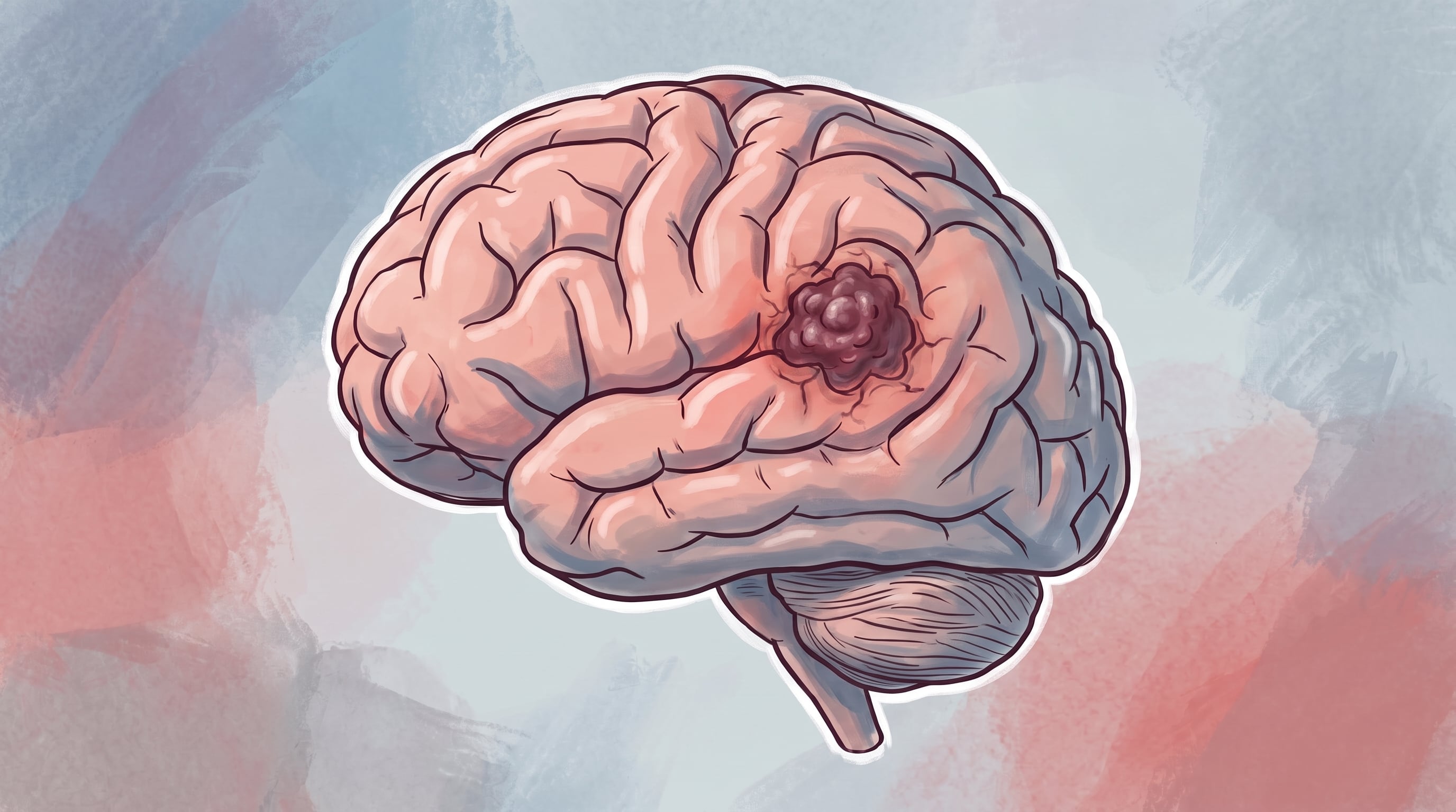 Una ilustración médica expone la presencia de un tumor en el tejido del cerebro humano. (Imagen Ilustrativa Infobae)