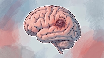 Ilustración de un cerebro humano de perfil con un tumor oscuro en el área lateral sobre un fondo pastel.