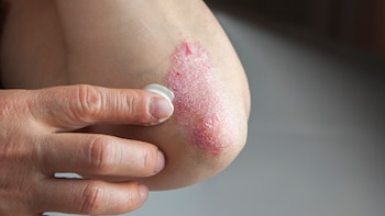 La psoriasis afecta al 2-3%