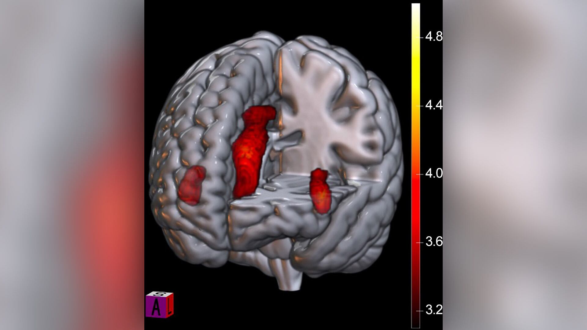 En rojo se muestran las áreas del cerebro donde la actividad disminuye durante una derrota significativa para los fanáticos del fútbol/Revista Radiology
