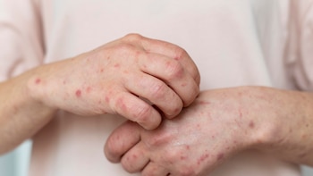 De picores en la piel a costras y úlceras: los síntomas que alertan de la sarna