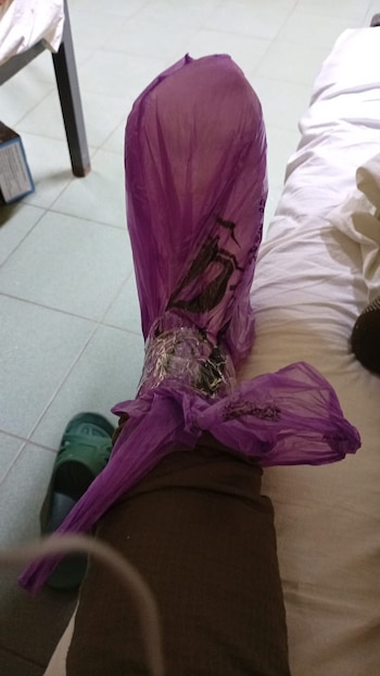 Um salvadorenho ferido numa zona de guerra na Rússia, forçado a proteger a perna quebrada com um saco plástico por falta de cuidados médicos e suprimentos básicos.