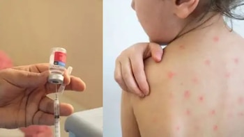 Brote de sarampión en Puno: casos se cuadruplican en tres días y prevén aumento en próximas semanas