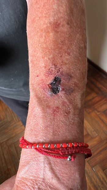 Una de las heridas que