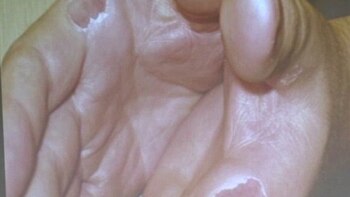 Las ampollas en las manos