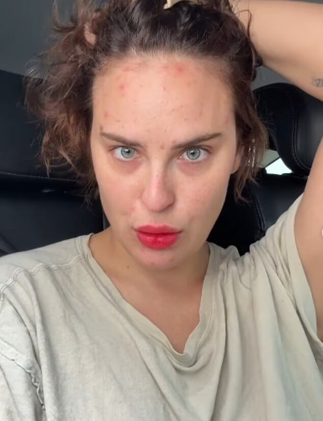 El trastorno compulsivo que padece puede provocar heridas y cicatrices visibles en el rostro.(Instagram/buuski)