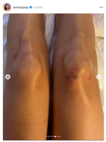 Así quedaron las rodillas de la cantante tras la caída. (IG: @belindapop)