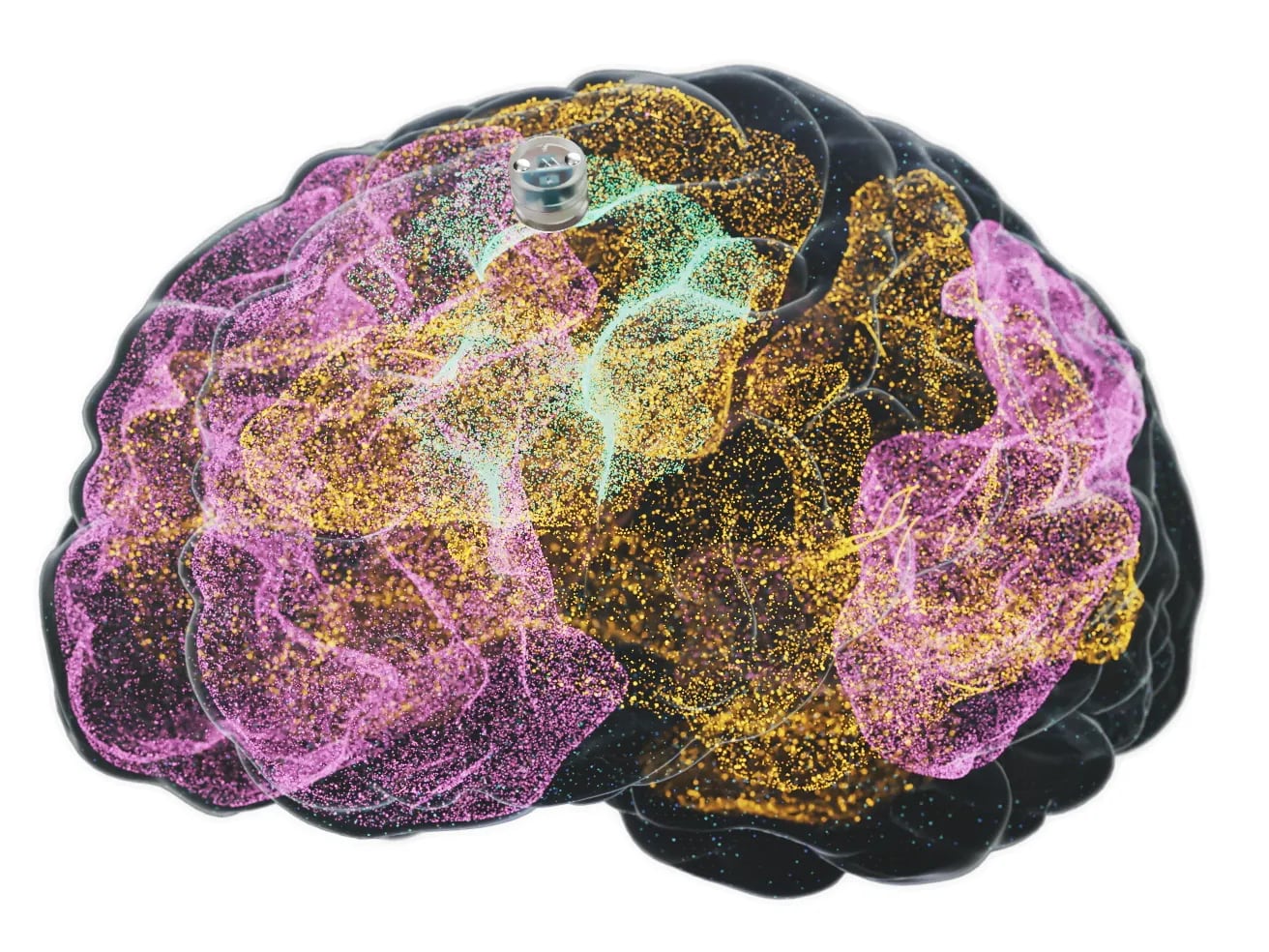 La compañía proyecta iniciar un ensayo clínico con implantes permanentes en pacientes con glioblastoma durante el próximo año. (Motif Neurotech)