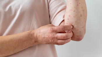 Rubeola: causas, síntomas y tratamiento