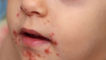 ¿Cómo tratar a un niño cuando presenta síntomas de coxsackie? Ministerio de Salud detalla cuidados esenciales