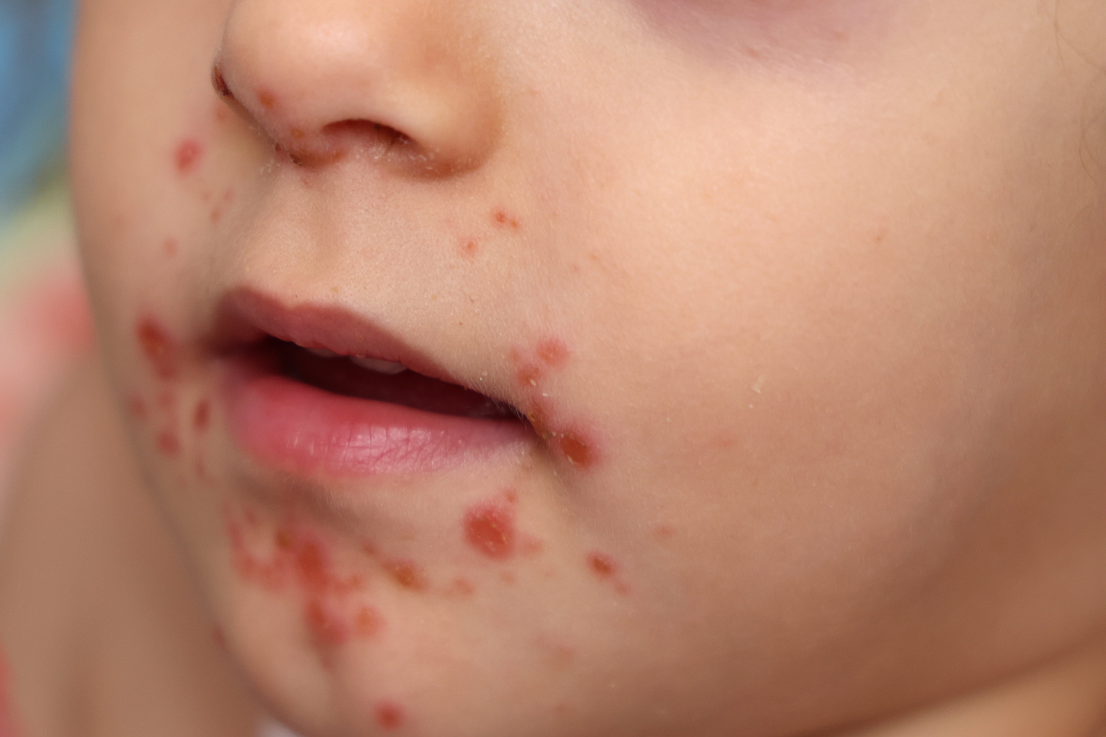 Little girl suffers of Coxsacki virus.