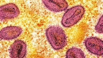 Acusan a dos científicos de ingresar muestras de viruela de mono a Estados Unidos