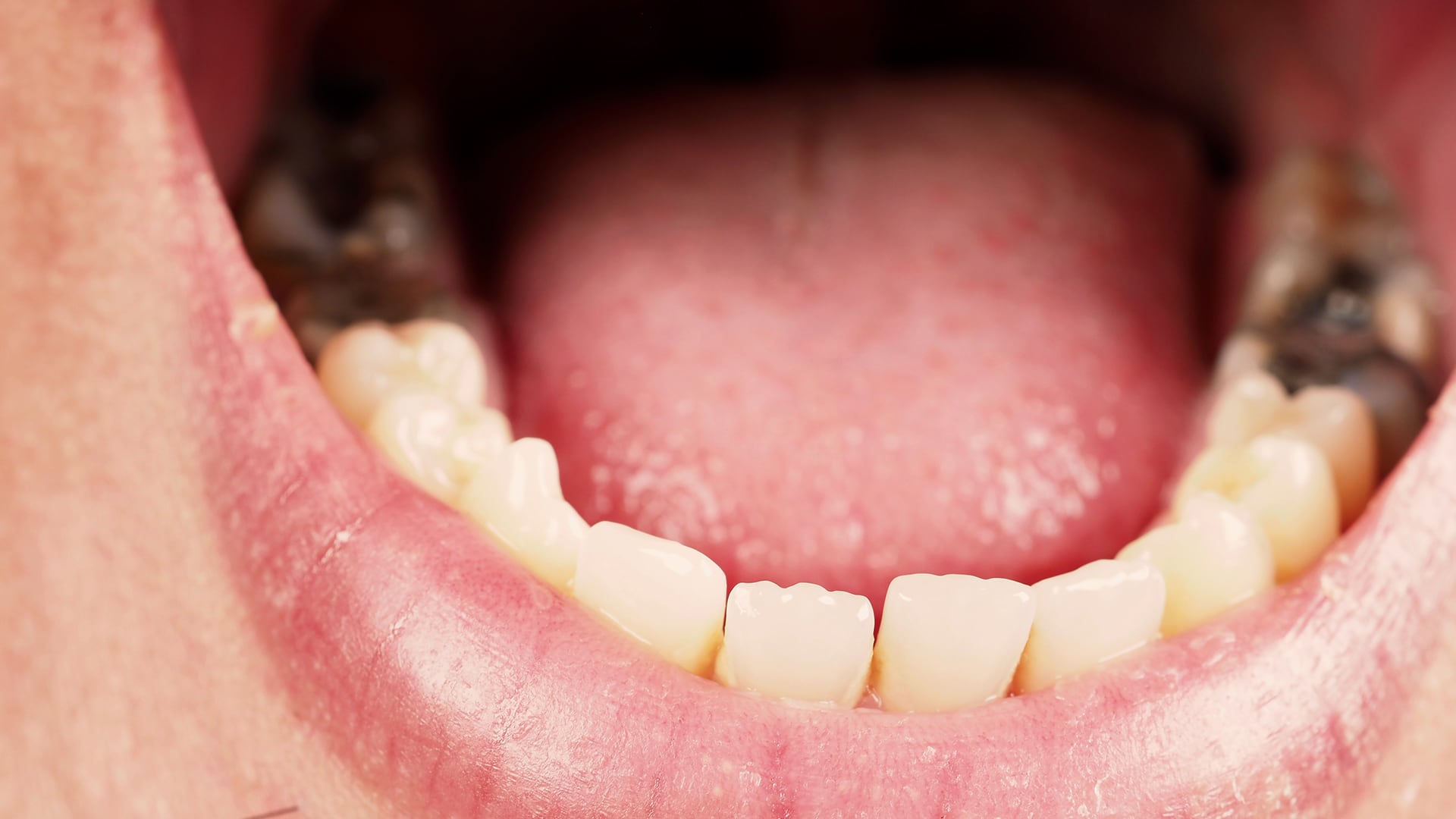 La reducción sostenida de la producción salival incrementa el riesgo de caries, infecciones por hongos y problemas de salud oral (Freepik)