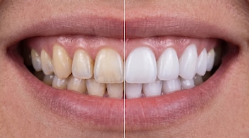 Primer plano de una boca abierta con dientes amarillentos en el lado izquierdo y dientes blancos y alineados en el lado derecho.