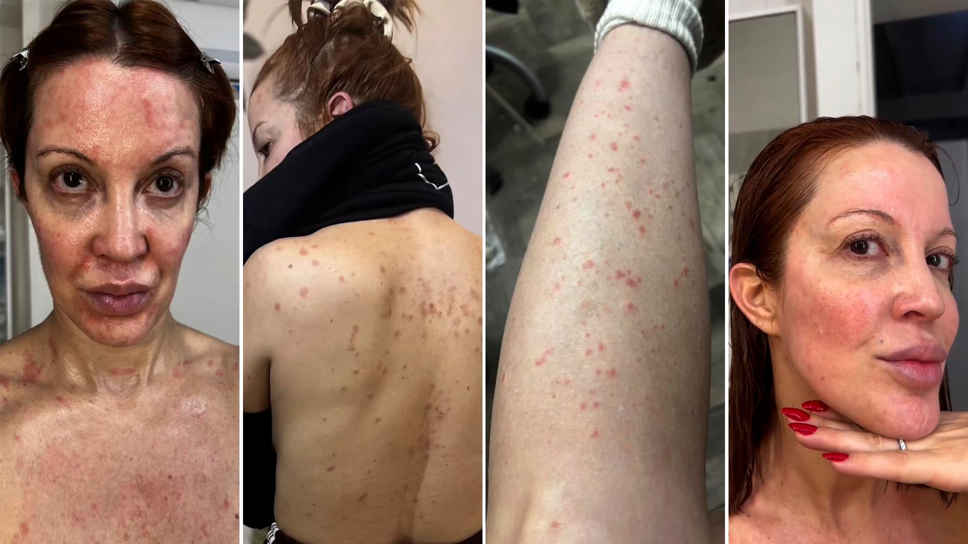 Miriam Lanzoni visibilizó la psoriasis al mostrar imágenes de sus brotes y relatar el impacto en su autoestima y vida profesional, arrojando luz sobre la afección