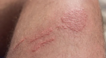 Las picaduras generan ardor enrojecimiento