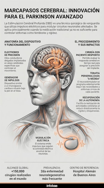 Descubre cómo la Estimulación Cerebral Profunda (DBS) revoluciona el tratamiento del Parkinson avanzado. Esta tecnología utiliza electrodos de precisión y un generador de impulsos para devolver la autonomía a los pacientes reduciendo temblores y rigidez. Una guía visual sobre el procedimiento y sus beneficios. InfografíaIA.