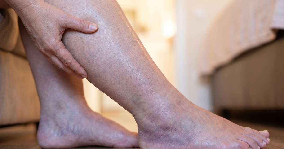 Una pierna inflamada, falta de aire o dolor en el pecho: los síntomas que pueden indicar una trombosis y exigen atención urgente