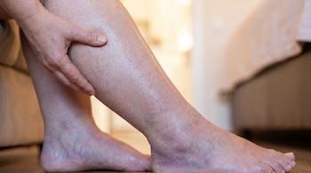 Primer plano de las piernas de una persona, con una mano tocando la pantorrilla. Se observan venas varicosas y tonalidad irregular en la piel.