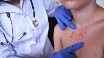 Sarampión en México: ¿Cuántos casos