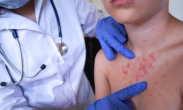 El brote actual se debe a varios años de coberturas bajas, distribución deficiente y olvido social según los análisis recientes. Foto: (iStock)