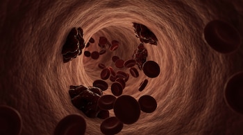 Imagen digital de una vena con su pared interna texturizada, glóbulos rojos esféricos y varios coágulos sanguíneos de color rojo oscuro.
