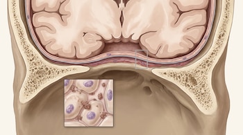 Corte transversal del cráneo y el cerebro con capas de tejido y un recuadro inferior que amplía células con núcleos y partículas agrupadas.